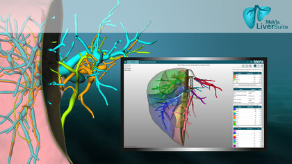 MeVis Liver Suite